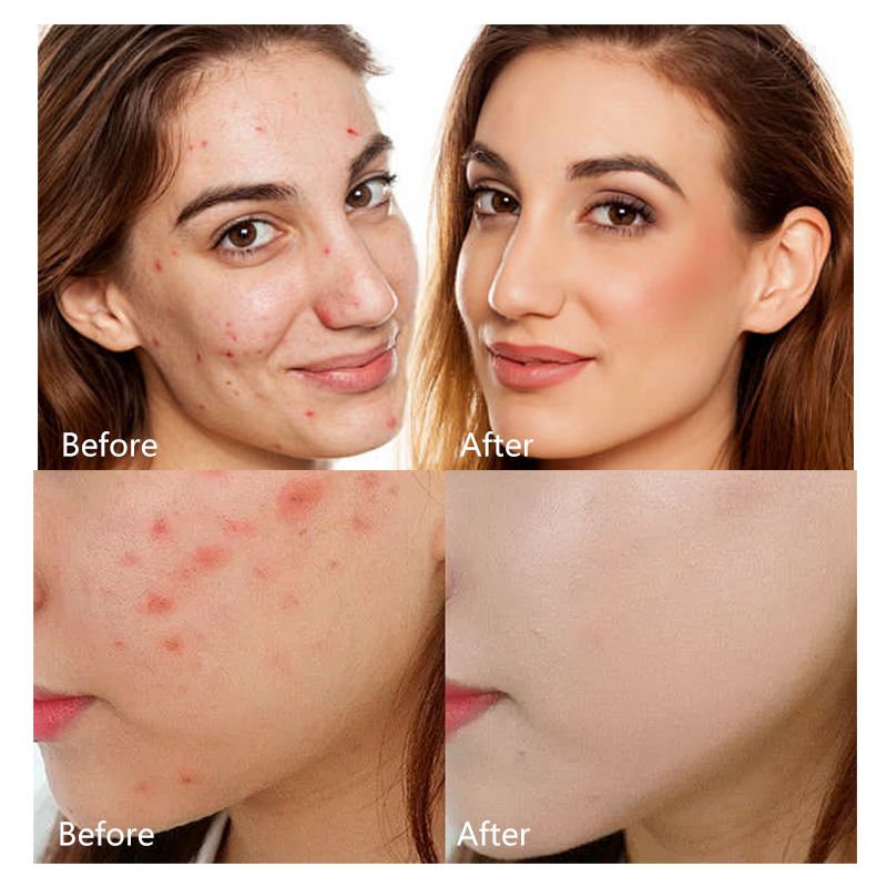 Salicylic Acid Soluble Microneedle Acne Patch, 9-Pack